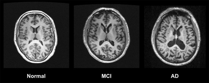 مقایسه بیماری MCI با AD (آلزایمر)