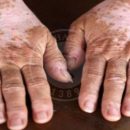فواید قارچ بر بیماری پیسی